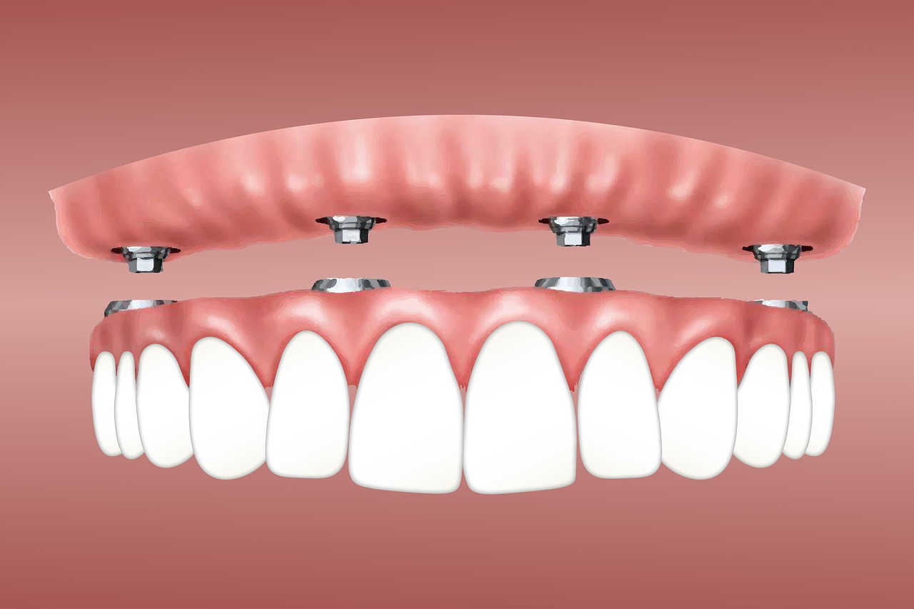 implanty stomatologiczne - kiedy stosować?